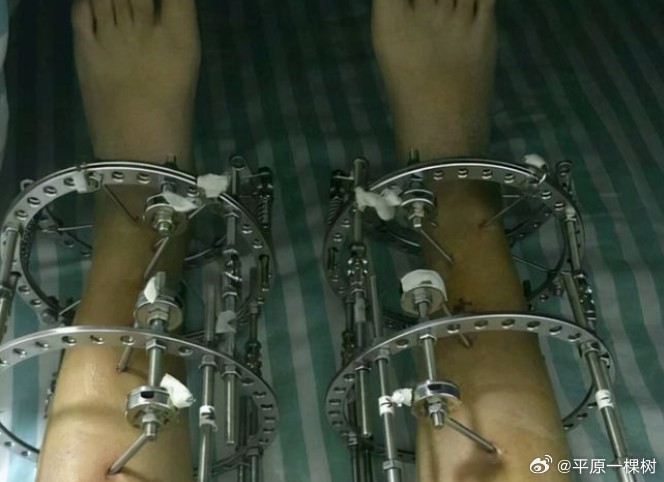 4498例！中国女孩花60多万来新加坡做增高手术，4次手术后反变长短腿终生残疾，靠止痛药续命……