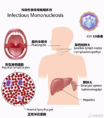 科普篇：认识传染性单核细胞增多症-亲吻病